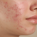 Acne