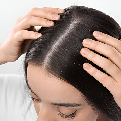 Dandruff