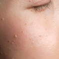 Uneven Skin